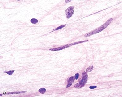 Fig. 6.2, Diffuse astrocytoma, fibrillary subtype, WHO grade II. (A) Intraoperative smear preparation reveals cells with elongate to irregular hyperchromatic nuclei, some of which display long cytoplasmic processes. (B, C) At the infiltrative edge, there are scattered individual or clustered mildly enlarged, elongated, irregular and hyperchromatic “naked nuclei” (arrowheads) along with native non-neoplastic cells, such as cortical neurons (arrows). (D) Even in regions composed predominantly of tumor cells, entrapped linear axons are evident (arrows). Microcystic changes are also seen. (E) The infiltrative nature is further supported by the presence of numerous entrapped axons on neurofilament protein immunostain. (F) A GFAP stain highlights irregular clusters of neoplastic cells with variable quantities of cytoplasm, along with a few coarse processes. (G) In contrast, a comparison case of gliosis demonstrates evenly spaced reactive astrocytes with numerous radially arranged processes, some of which terminate on blood vessels (astrocytic end-feet). (H) Immunohistochemistry for IDH R132H is positive in the cytoplasm of the IDH-mutant astrocytoma cells and is highly specific for neoplastic rather than reactive or entrapped normal cells. (I) ATRX expression is lost in most IDH-mutant astrocytomas, with neoplastic nuclei appearing negative. Non-neoplastic elements, including endothelial cells, glial cells, and neurons, maintain immunoreactivity, serving as a positive internal control. (J) Immunohistochemistry for p53 is often strong in over 10% of tumor nuclei in most IDH-mutant astrocytomas, but can also be noted in a smaller subset of IDH-wildtype and H3 K27M-mutant astrocytomas. (K) The Ki-67 labeling index is often low, but staining of enlarged atypical nuclei provides additional support for astrocytoma, rather than a reactive process.