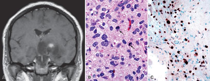 Fig. 6.3, Anaplastic astrocytoma, WHO grade III. (A) Postcontrast T1-weighted MRI showing modest, focal contrast enhancement within a much larger region of hypodensity in the left basal ganglia and temporal lobe. (B) Anaplastic astrocytomas are cytologically and immunohistochemically similar to WHO grade II astrocytomas, but are generally more cellular and have mitotic figures (arrows). (C) The MIB-1 (Ki-67) immunostain shows an increased labeling index, commonly reaching over 5%.