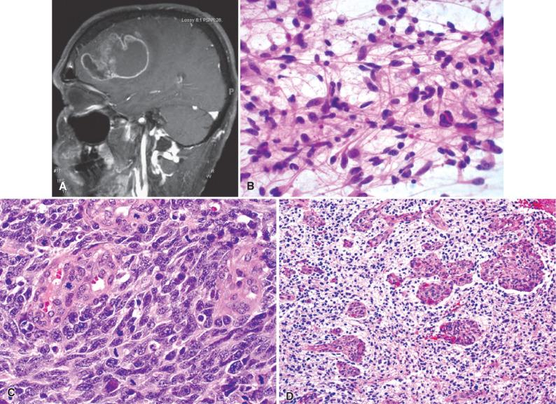 Fig. 6.4, Glioblastoma, WHO grade IV. (A) Postcontrast MRI of glioblastoma showing deep-seated irregular rim-enhancing mass in the frontal lobe. (B) Intraoperative sampling from a viable portion of a glioblastoma produces a cellular smear with cytologic features of fibrillary astrocytoma (compare with Fig. 6.2A ). (C) Viable portion of a glioblastoma, showing marked cellularity, mitotic activity, and typical microvascular hyperplasia characterized by small multilayered vessels with plump (hyperplastic) endothelia. (D) “Glomeruloid” bodies represent larger tufts of microvascular hyperplasia with multiple lumens. However, the multilayering is the more important diagnostic feature, rather than the multiple lumens resembling glomeruli. (E, F) Immunohistochemical studies show that the microvascular proliferation consists not only of CD34-positive endothelia (E), but also smooth muscle actin-positive cells (F). (G) Palisading necrosis in a glioblastoma. (H) Infarct-like necrosis in glioblastoma. (I) Occasional glioblastomas show foci with perivascular pseudorosette-like structures. This should not be misconstrued as ependymal differentiation if other features are classic for GBM. (J) FISH findings in IDH-wildtype GBM frequently include EGFR amplification (40% to 60%). Chromosome 7 centromere = green (mostly two or three signals), EGFR gene = red (many signals). DAPI nuclear counterstain (blue). (K) Loss of chromosome 10 is the most frequent cytogenetic alteration in IDH-wildtype GBM. PTEN gene (10q23) = green (mostly one signal), DMBT1 gene (10q25-q26) = red (mostly one signal).