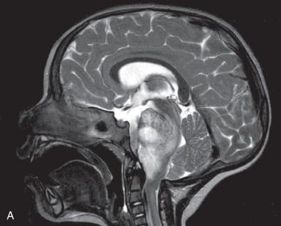 Fig. 6.5, Diffuse midline gliomas with H3 K27M mutations. (A–D) Pontine example. Large “brainstem glioma” on midsagittal T2-weighted MR imaging, centered on the pons (A). This is a typical location for H3 K27M-mutant diffuse midline gliomas. In this case, the histology shows a cellular, diffuse astrocytic neoplasm with mitotic activity resembling anaplastic astrocytoma (B). However, the presence of diffuse nuclear H3 K27M positivity (C) and loss of H3K27me3 expression (D) establishes this as a “diffuse midline glioma, H3 K27M-mutant,” which is considered a WHO grade IV neoplasm by definition. (E–G) Spinal example. This adolescent patient presented with a large nonenhancing cervicomedullary tumor showing increased signal on midsagittal T2-weighted MRI (E). Despite the modest hypercellularity and minimal nuclear atypia on routine H & E stain (F), the H3 K27M stain (G) suggested that the vast majority of cells were neoplastic in this diffuse midline glioma, H3 K27M-mutant that is deceptively low grade in appearance.