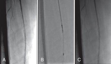 FIG 18.2, Angiogram demonstrating use of TurboHawk system in heavily calcified lesions.