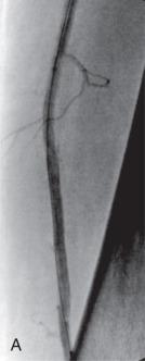 FIG 18.3, Chronic total occlusion of the superficial femoral artery.