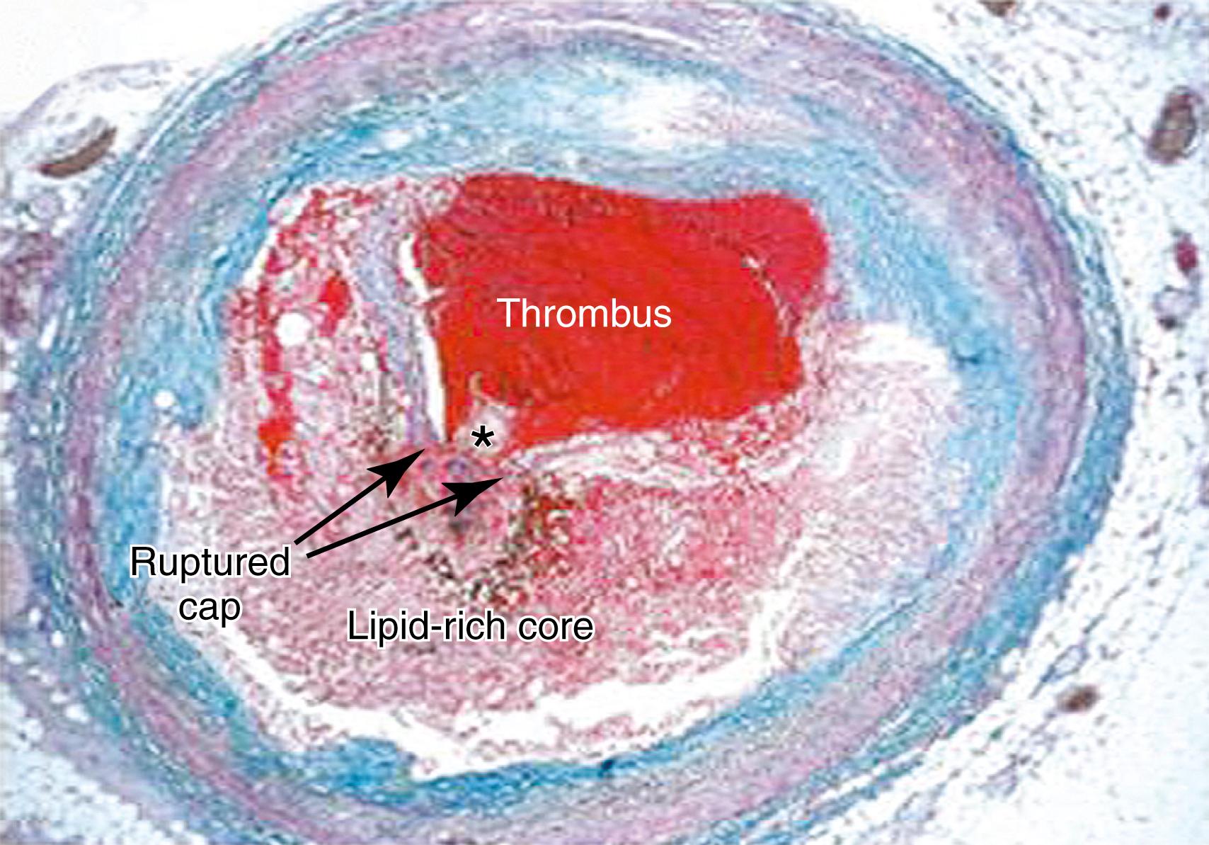 Figure 4.1, Thrombotic Complication of a Fibroatheroma Seen on a Trichrome-Stained Cross-Section of a Human Coronary Artery.