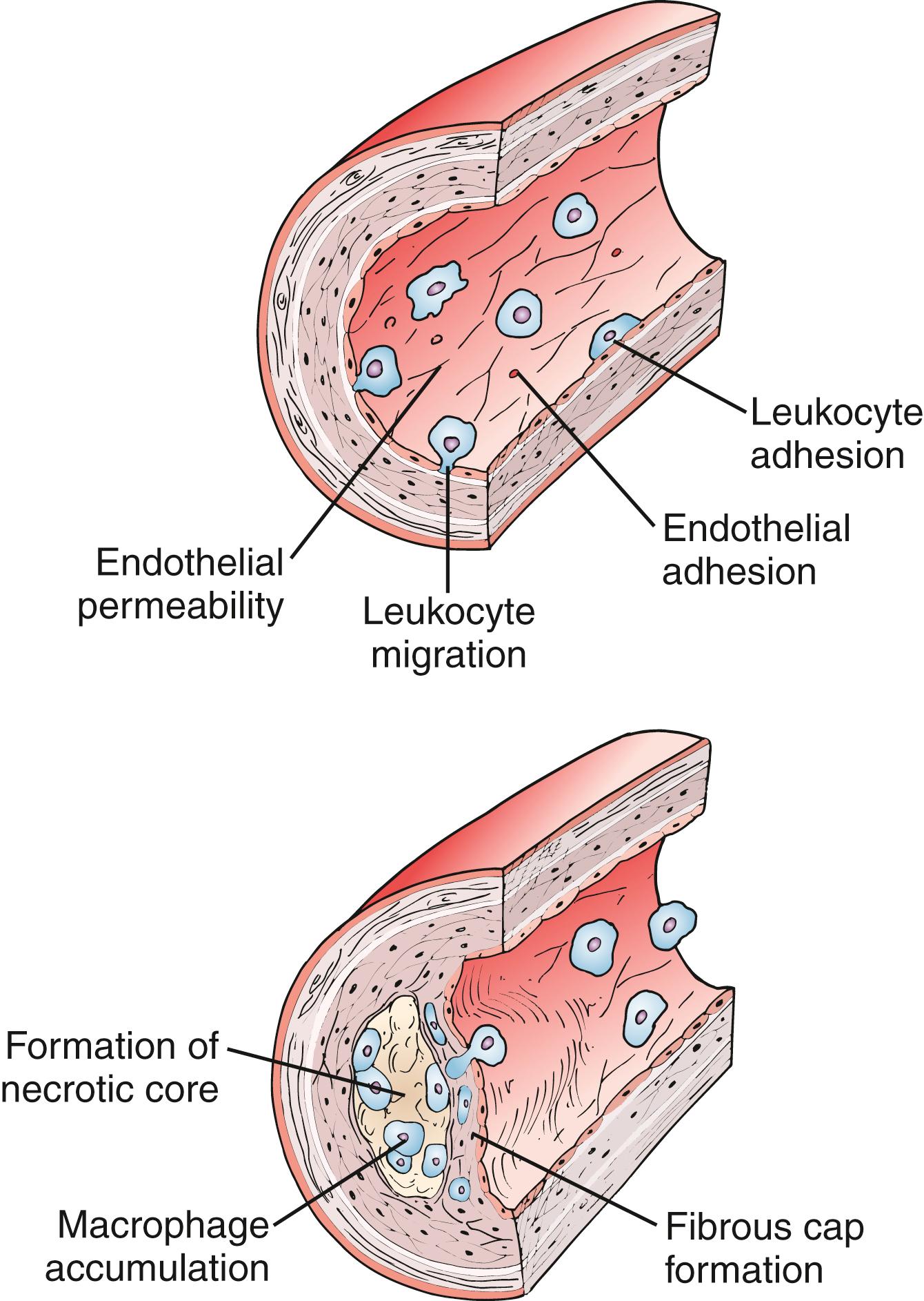 Figure 4.2, Initiation and Progression of Atherosclerotic Plaque.