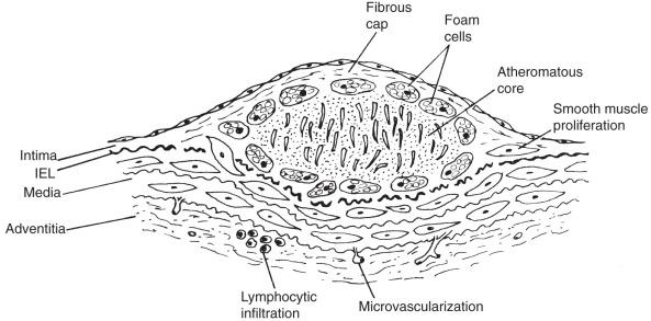 FIG 7.1, Typical Atheroma or Type IV Lesion.