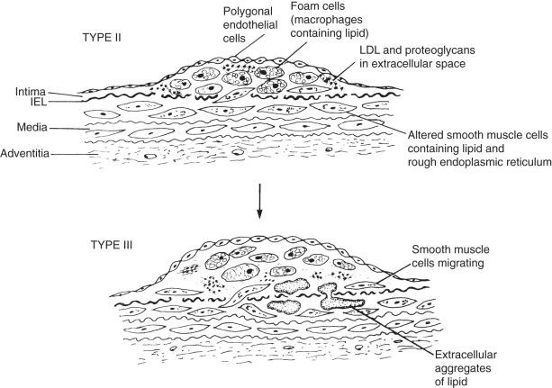 FIG 7.3, Type II fatty streak lesions with foam cells. Note the low-density lipoprotein (LDL) particles in the matrix and altered smooth muscle cells, with developed rough endoplasmic reticulum also containing lipid particles. Note too the evolution to an intermediate, more advanced lesion (type III) containing extracellular aggregates or pools of lipid deep in the intima and extending into the media. IEL, Internal elastic lamina.