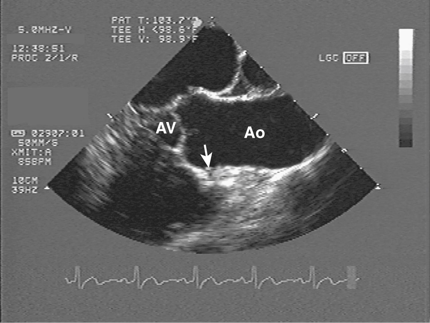 Fig. 33.1, Longitudinal view of the ascending aorta (AO) by transesophageal echocardiography. The entire ascending aorta is visualized, from the aortic valve (AV) to the initial curvature of the aortic arch. The take-off of the right coronary artery is visible (arrow) .