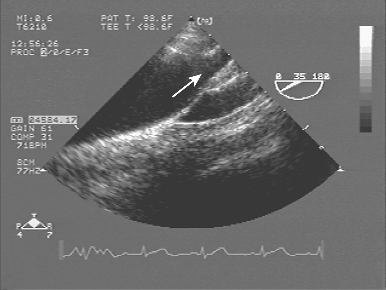Fig. 33.2, Transesophageal echocardiography visualization of the mid to distal portion of the aortic arch. The take-off of the left subclavian artery is visible (arrow) .