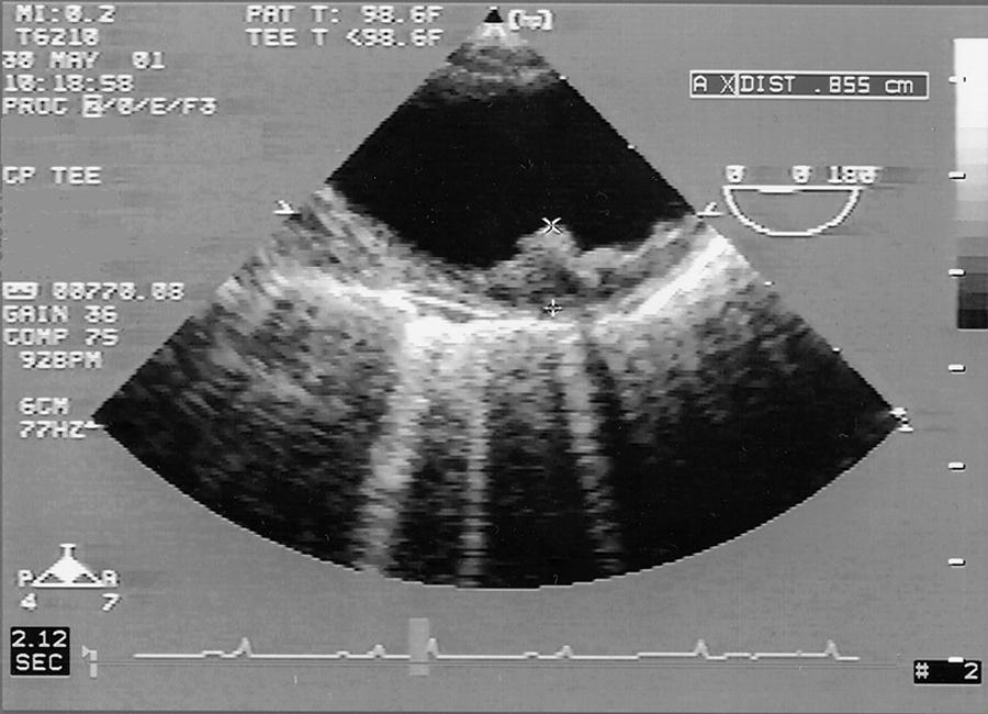 Fig. 33.3, Protruding atherosclerotic plaque in the distal aortic arch. Measurement of plaque thickness, perpendicular to the major axis of the aortic lumen, is shown. Plaque thickness (0.855 cm) is displayed in the upper right corner.