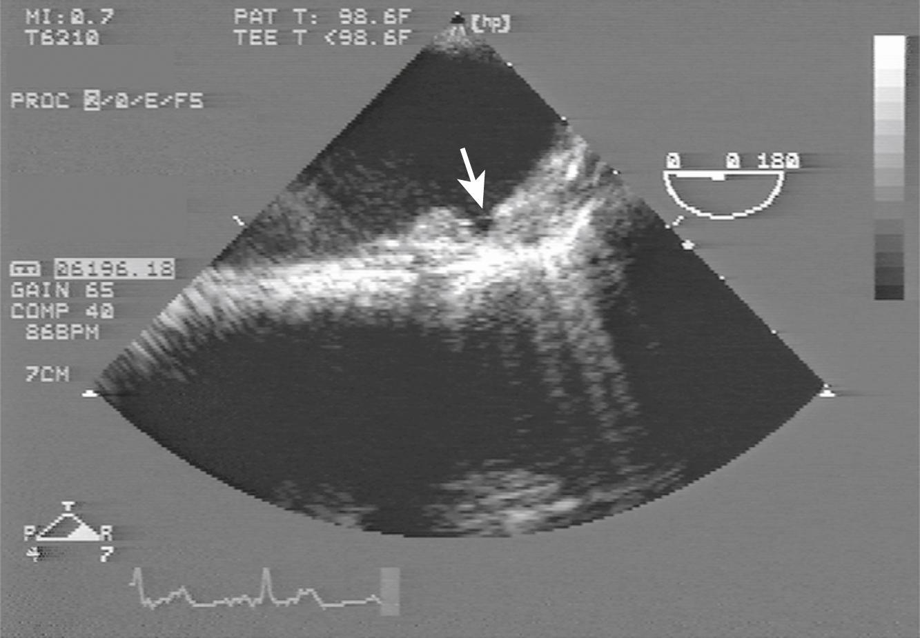 Fig. 33.4, Complex plaque in the distal aortic arch. A large ulceration (arrow) is visible.