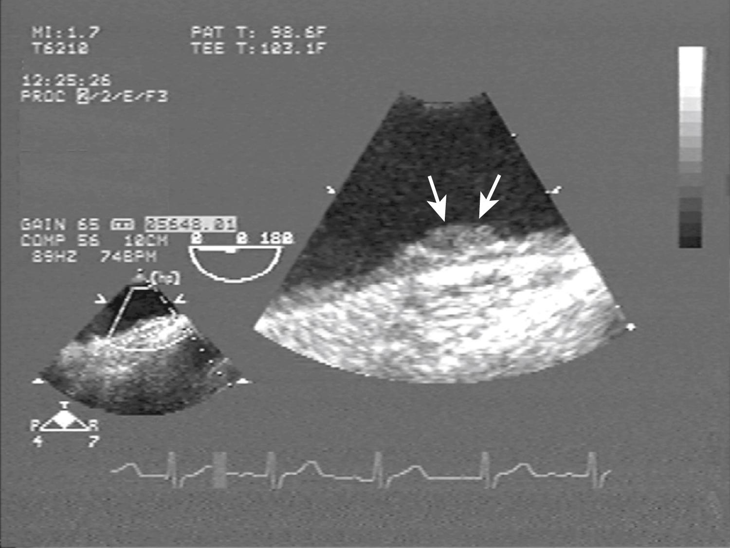 Fig. 33.5, Enlarged view of a plaque in the midportion of the aortic arch. Hypoechoic material suggestive of thrombus (arrows) appears superimposed to the brightly echogenic plaque.