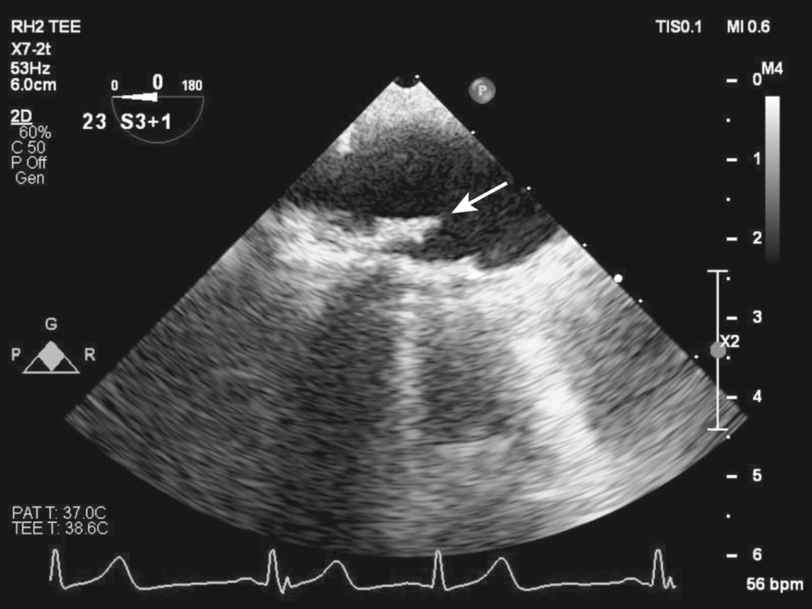 Fig. 33.6, Complex plaque in the midportion of the aortic arch. A large pedunculated portion is seen (arrow), which was highly mobile in real-time imaging (also see Video 33.1 ).