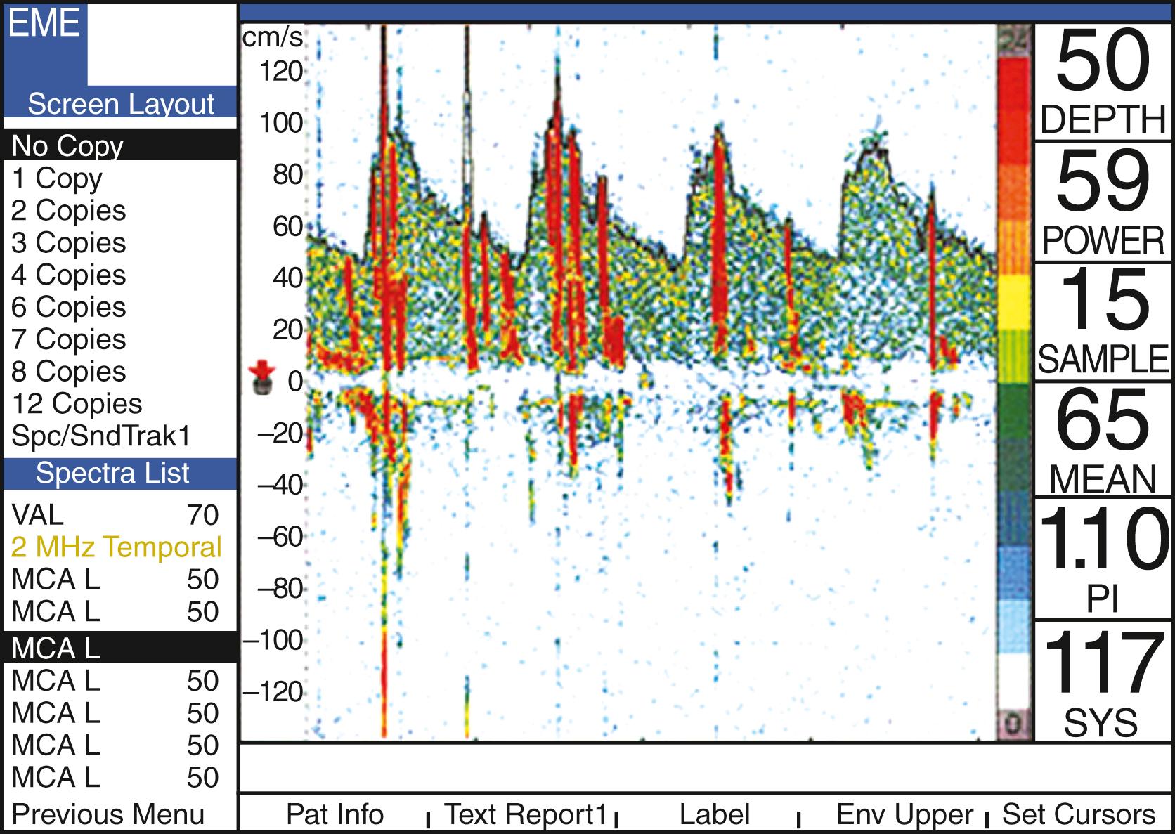 Fig. 33.8, Transcranial Doppler examination of the middle cerebral artery. High-intensity transient signals are visualized as vertical high-amplitude signals with narrow spectrum superimposed to the normal blood flow.