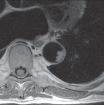 FIG. 27.1, An example of multicontrast plaque imaging with cardiovascular magnetic resonance.