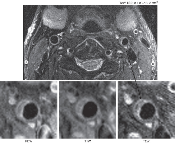 FIG. 27.2, An example of multicontrast cardiovascular magnetic resonance plaque imaging at high field strength (3 T). A nonstenotic plaque is well visualized in the left carotid artery. The fibrous cap and lipid core can be seen on the high-magnification images. PDW , Proton density weighted; T1W , T1 weighted; T2W, T2 weighted.