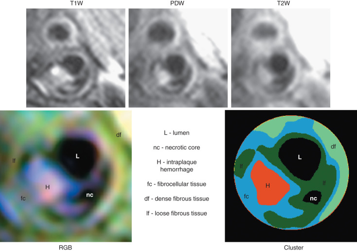 FIG. 27.3, Multicontrast cardiovascular magnetic resonance images of the carotid artery. Top row shows T1-weighted (T1W) , proton density weighted (PDW) and T2-weighted (T2W) images of the same atherosclerotic plaque. The bottom left panel shows the red-green-blue (RGB) color composite image obtained by mapping the T1W image to the red, the PDW image to the green, and the T2W image to blue channel, respectively. The bottom right panel shows the plaque segmented automatically into its various components using an automated k -means cluster analysis algorithm. Intraplaque hemorrhage (H) , necrotic core (nc) , loose (lf) , dense fibers (df) and the fibrous cap (fc) can be clearly differentiated.