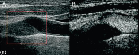 Figure 8.1, (a) Plaque without contrast-agent enhancement. (A) Large, predominantly hypoechoic plaque, at the origin of the internal carotid artery. (B) No plaque enhancement can be detected by contrast-enhanced ultrasound imaging. (b) Contrast enhanced plaque. Three consecutive frames of contrast-enhanced ultrasound imaging of an atherosclerotic lesion in the carotid bulb, showing contrast microbubbles ( arrowhead ) within the plaque. Corresponding micrograph showed a hemorrhagic fibrocalcific plaque with an eccentric large necrotic core occupying approximately 60% of the plaque area.