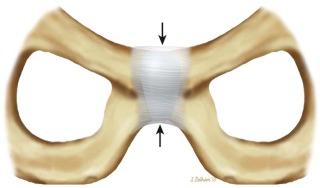 FIGURE 21–1, Line drawing of the pubic symphysis and pubic bones viewed from the front. The joint space is largely filled by intraarticular disk (arrows) with bridging capsule and capsular ligaments (horizontal lines).