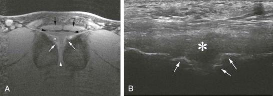 eFIGURE 21–2, A , High-resolution T2-weighted fast spin-echo MR image shows articular hyaline cartilage (asterisks) covering the anterior and medial joint surfaces with protrusions of ossification (white arrows), intervening disk (white arrowhead), capsular tissues (black arrowheads), and rectus abdominis (black arrows). B , Corresponding transverse axial sonogram shows normal undulation of anterior pubic cortices due to asymmetric ossification (white arrows). The disk is not so easily determined merging with the anterior capsule and aponeurotic tissues (asterisk).