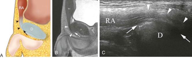 eFIGURE 21–3, Line drawing ( A ), sagittal T2-weighted MR image ( B ), and longitudinal sonogram ( C ) of the pubic symphysis at the level of the disk (D) show anterior articular cartilage (white arrows) and merger of capsular tissues with the tendon (white arrowheads) of rectus abdominis (RA).