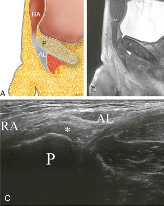 FIGURE 21–2, Line drawing ( A ), sagittal T2-weighted MR image ( B ), and longitudinal sonogram ( C ) of the pubic body (P) show the articular cartilage (white arrows), anterior capsule (asterisk) merging with rectus abdominis/pyramidalis (RA), and adductor longus (AL).