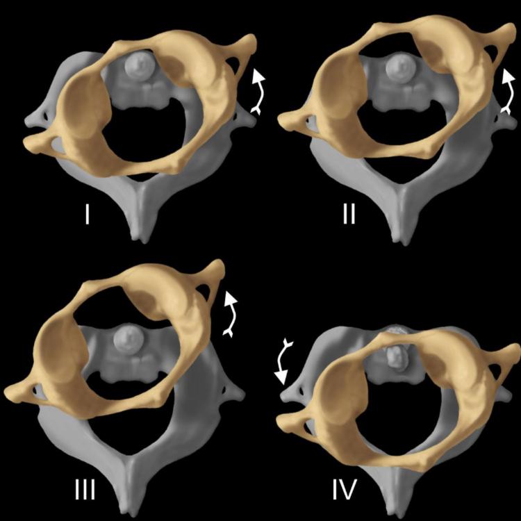 Atlantoaxial Rotatory Fixation Clinical Tree 0669