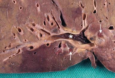 Figure 16-101, Focal pulmonary hemorrhage.