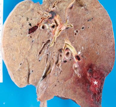 Figure 16-102, Acute pulmonary infarct.