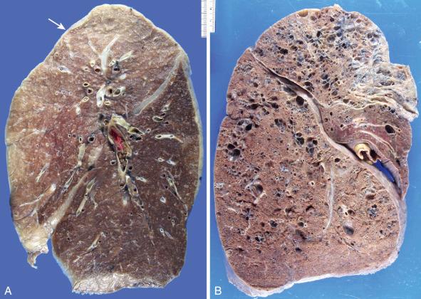 Figure 16-104, Centriacinar (centrilobular) emphysema.