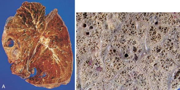 Figure 16-106, Panacinar emphysema.