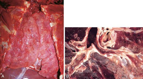 Figure 16-108, Sudden death in a patient with asthma.