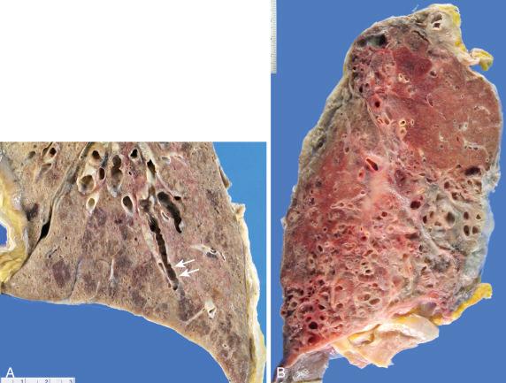 Figure 16-109, Bronchiectasis.