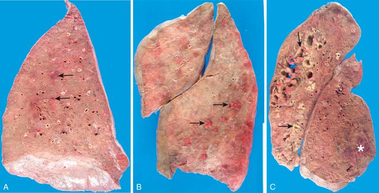 Figure 16-110, Aspiration pneumonia.