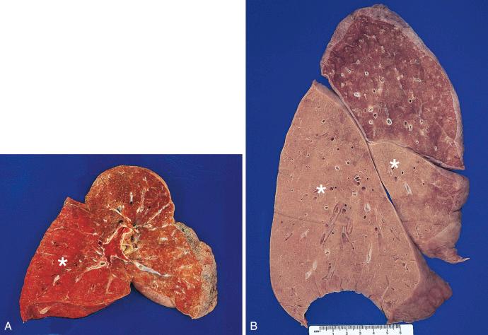 Figure 16-111, Bacterial lobar pneumonia.