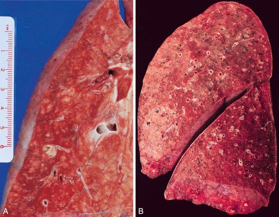 Figure 16-112, Bronchopneumonia.