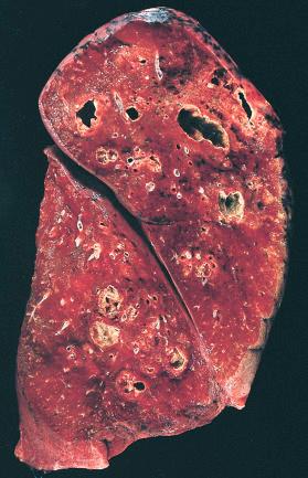 Figure 16-113, Lung abscess.