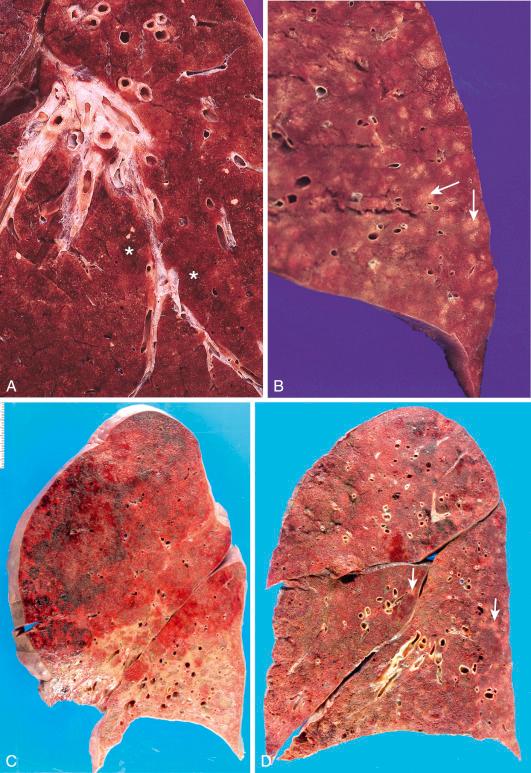 Figure 16-114, Viral pneumonias.