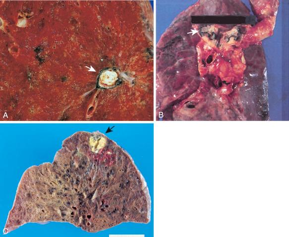 Figure 16-115, Tuberculosis.