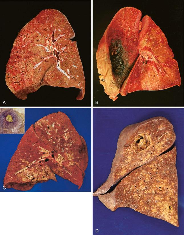 Figure 16-118, Fungal pneumonia.