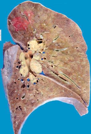 Figure 16-119, Pulmonary sarcoidosis.