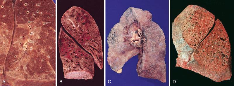Figure 16-120, Idiopathic pulmonary fibrosis.