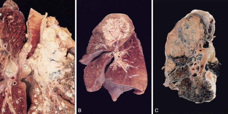 Figure 16-121, Lung carcinoma.