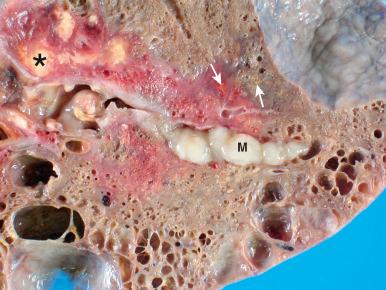 Figure 16-122, Postobstructive pneumonia.