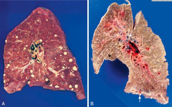 Figure 16-123, Metastatic tumors in lung.