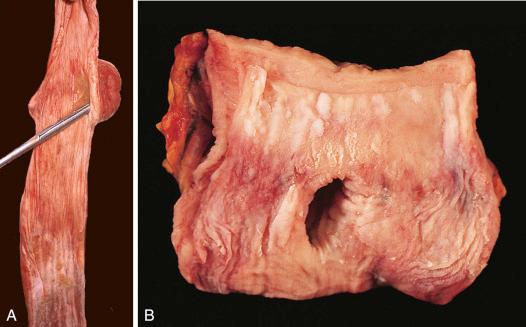 Figure 16-124, Esophageal diverticula.