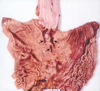 Figure 16-125, Gastroesophageal tears.