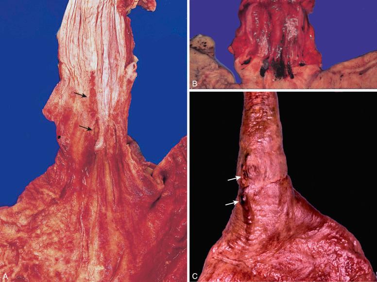 Figure 16-126, Esophageal varices.