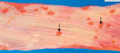 Figure 16-128, Viral esophagitis.