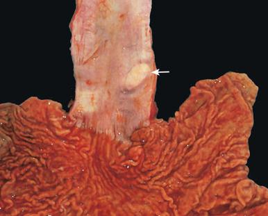 Figure 16-130, Esophageal leiomyoma.