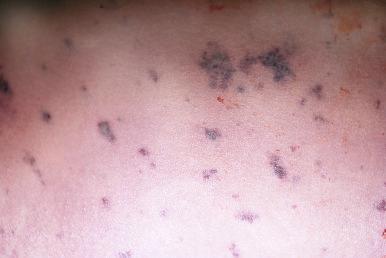 Figure 16-13, Petechiae and purpural hemorrhages.